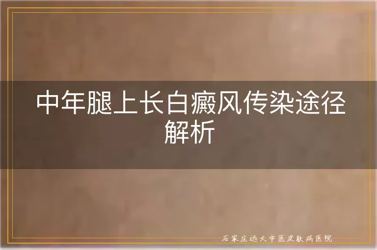 中年腿上长白癜风传染途径解析