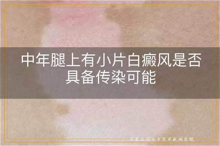 中年腿上有小片白癜风是否具备传染可能