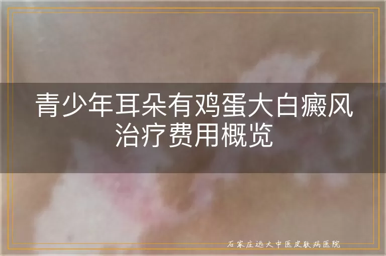 青少年耳朵有鸡蛋大白癜风治疗费用概览