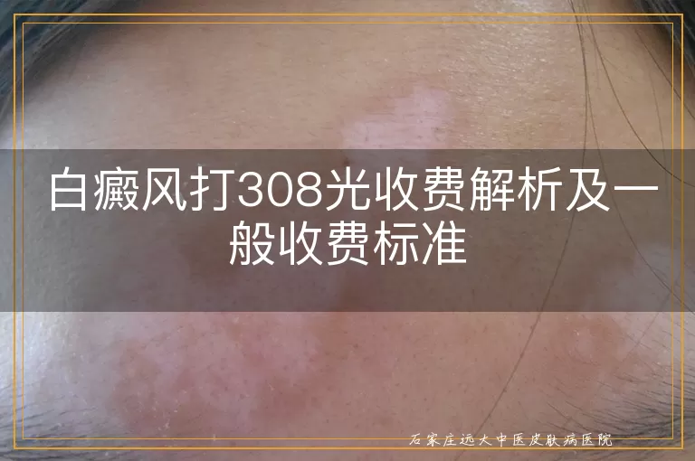 白癜风打308光收费解析及一般收费标准