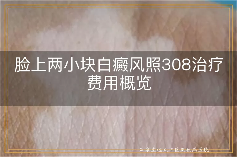 脸上两小块白癜风照308治疗费用概览
