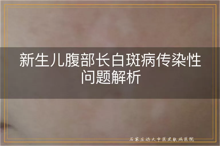 新生儿腹部长白斑病传染性问题解析