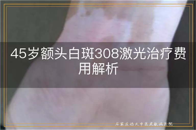 45岁额头白斑308激光治疗费用解析