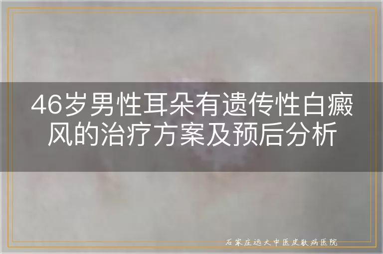 46岁男性耳朵有遗传性白癜风的治疗方案及预后分析