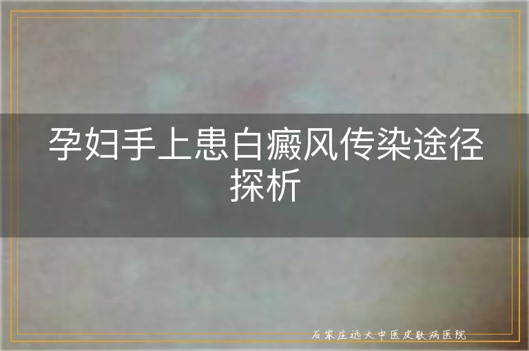 孕妇手上患白癜风传染途径探析