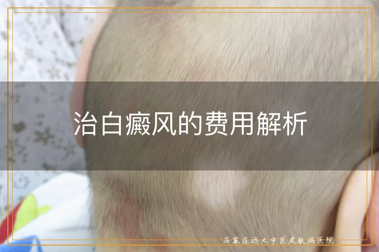 治白癜风的费用解析