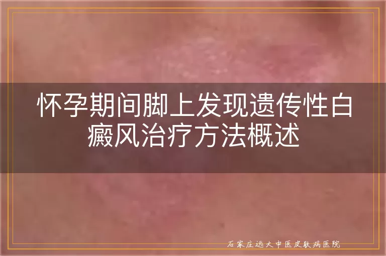 怀孕期间脚上发现遗传性白癜风治疗方法概述