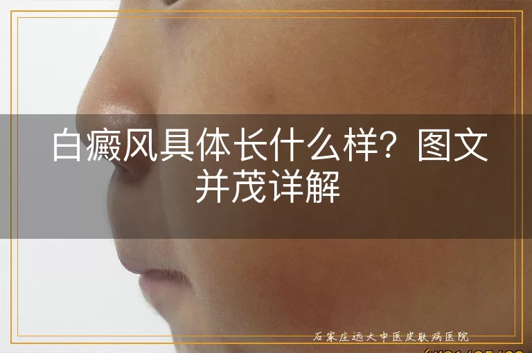 白癜风具体长什么样？图文并茂详解