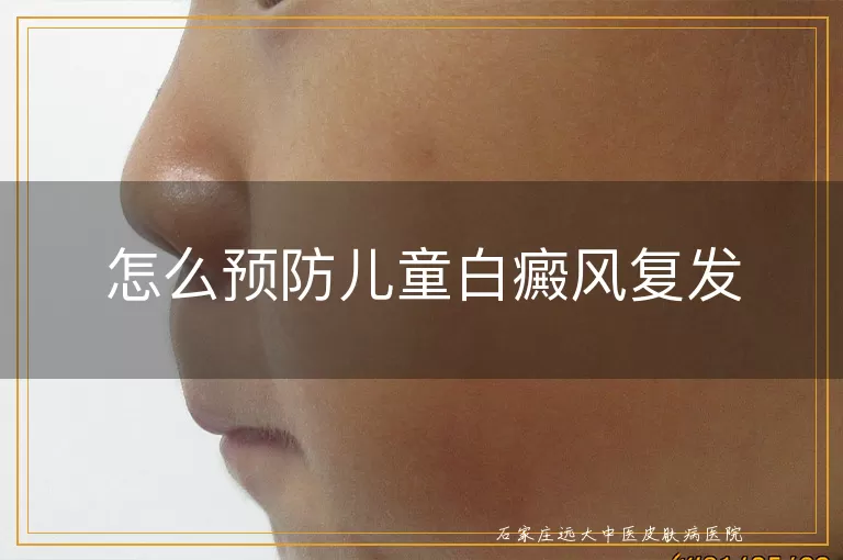 怎么预防儿童白癜风复发