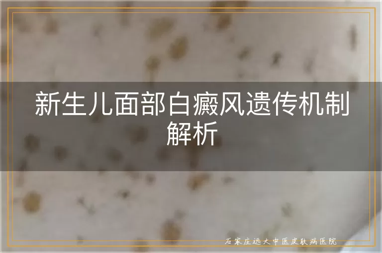 新生儿面部白癜风遗传机制解析