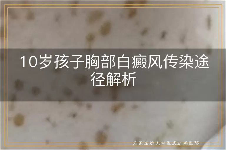 10岁孩子胸部白癜风传染途径解析