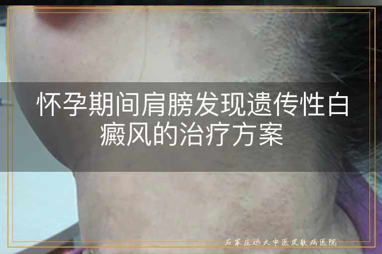 怀孕期间肩膀发现遗传性白癜风的治疗方案