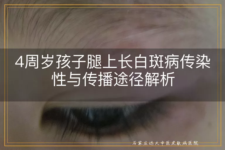 4周岁孩子腿上长白斑病传染性与传播途径解析