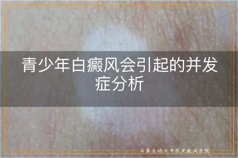 青少年白癜风会引起的并发症分析