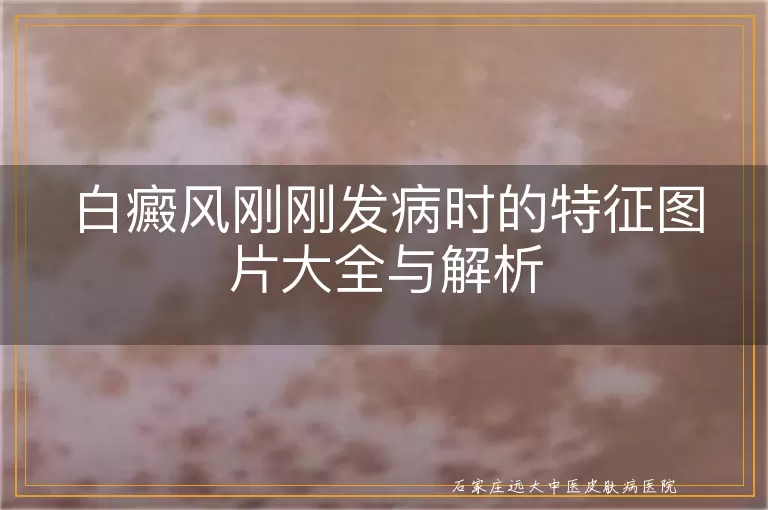 白癜风刚刚发病时的特征图片大全与解析
