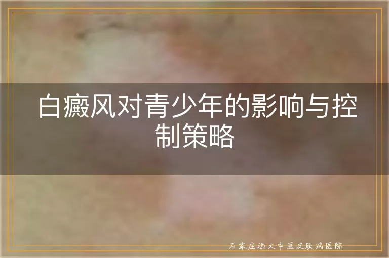 白癜风对青少年的影响与控制策略
