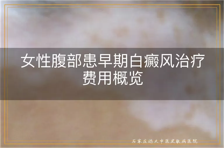 女性腹部患早期白癜风治疗费用概览