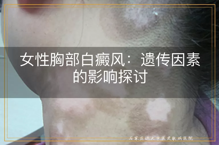 女性胸部白癜风：遗传因素的影响探讨