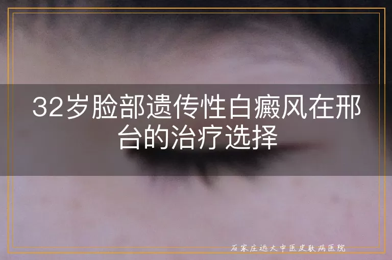 32岁脸部遗传性白癜风在邢台的治疗选择