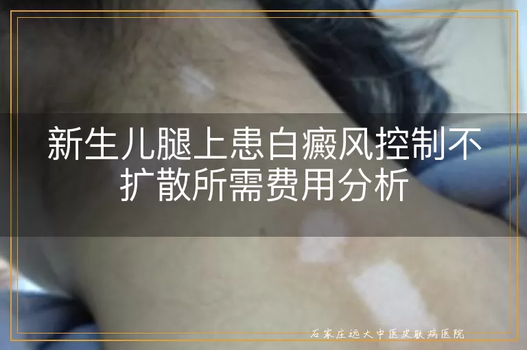 新生儿腿上患白癜风控制不扩散所需费用分析