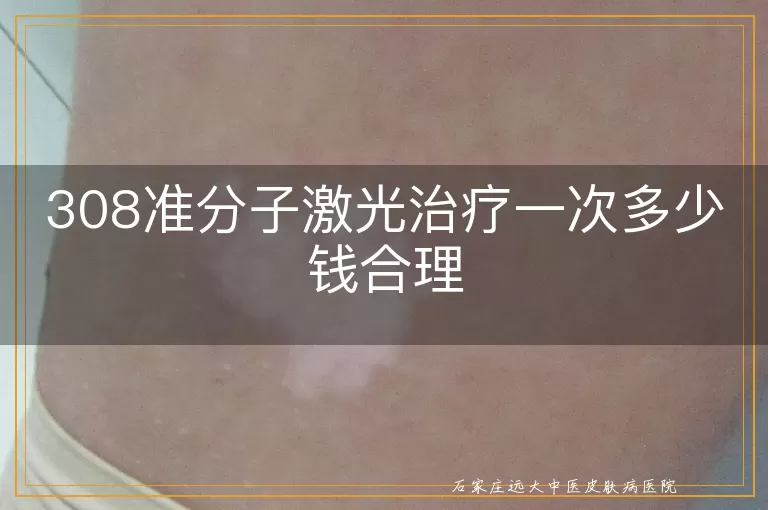 308准分子激光治疗一次多少钱合理