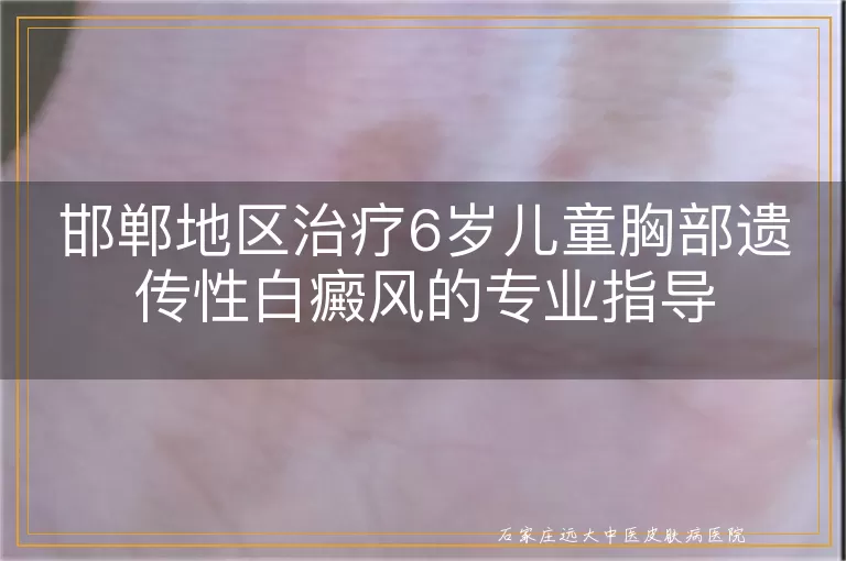 邯郸地区治疗6岁儿童胸部遗传性白癜风的专业指导