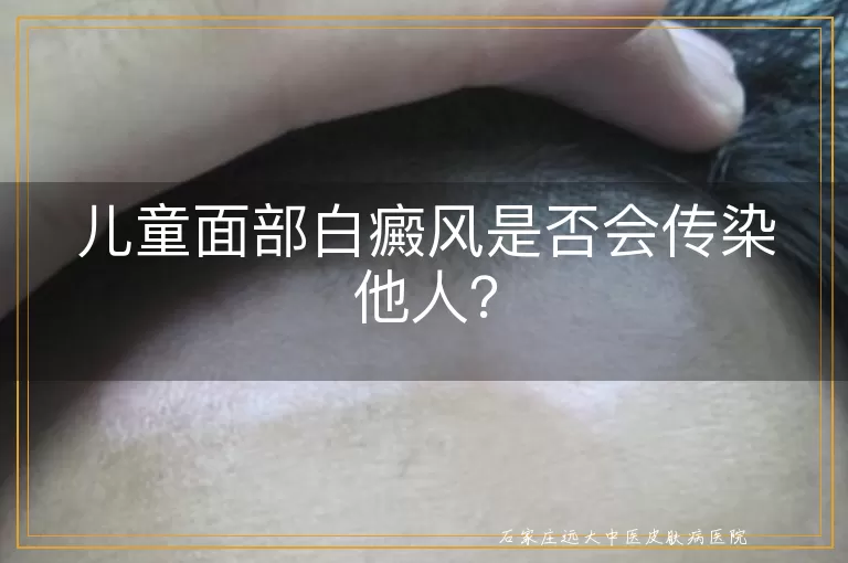 儿童面部白癜风是否会传染他人？