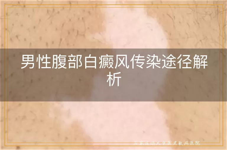 男性腹部白癜风传染途径解析