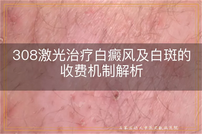 308激光治疗白癜风及白斑的收费机制解析