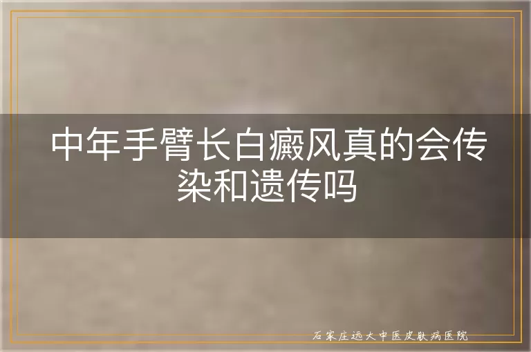 中年手臂长白癜风真的会传染和遗传吗