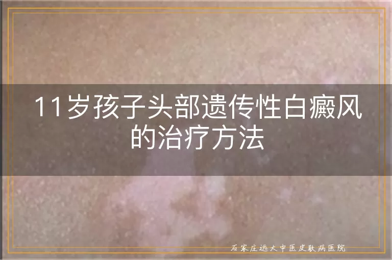 11岁孩子头部遗传性白癜风的治疗方法
