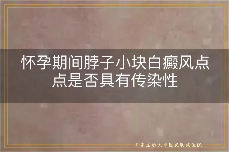 怀孕期间脖子小块白癜风点点是否具有传染性