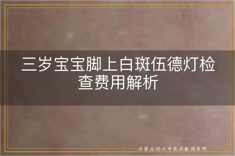 三岁宝宝脚上白斑伍德灯检查费用解析