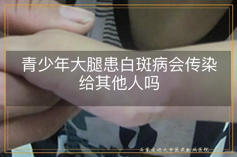 青少年大腿患白斑病会传染给其他人吗
