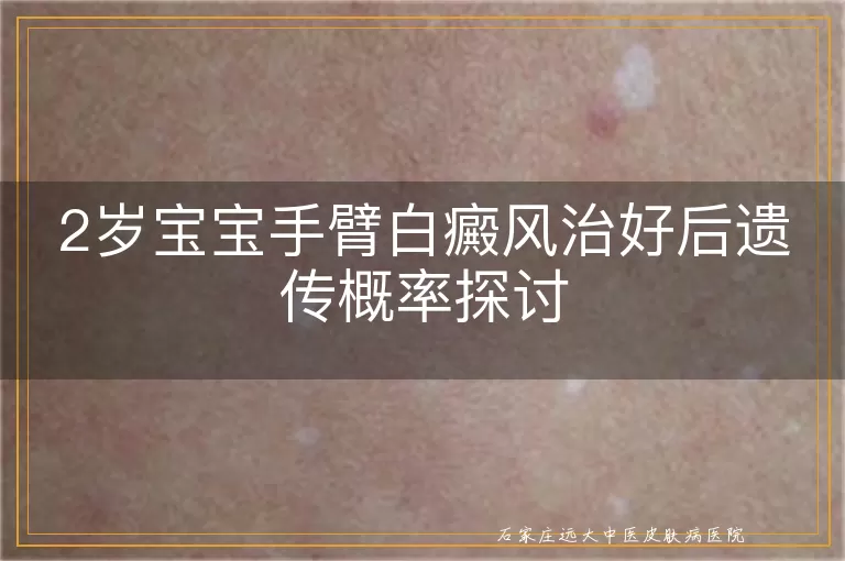 2岁宝宝手臂白癜风治好后遗传概率探讨