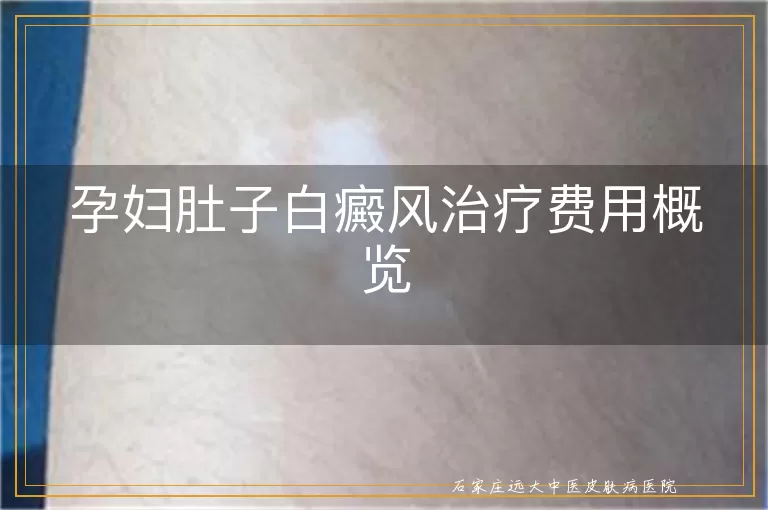 孕妇肚子白癜风治疗费用概览