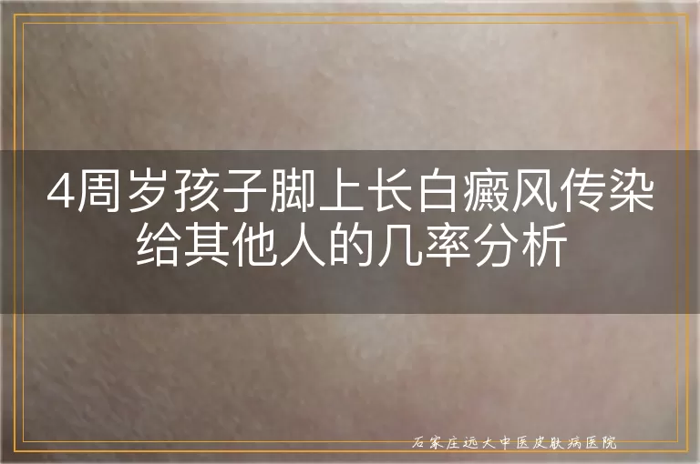 4周岁孩子脚上长白癜风传染给其他人的几率分析