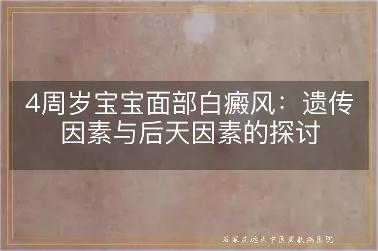 4周岁宝宝面部白癜风：遗传因素与后天因素的探讨