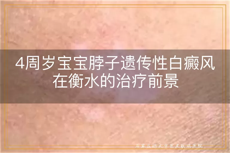 4周岁宝宝脖子遗传性白癜风在衡水的治疗前景