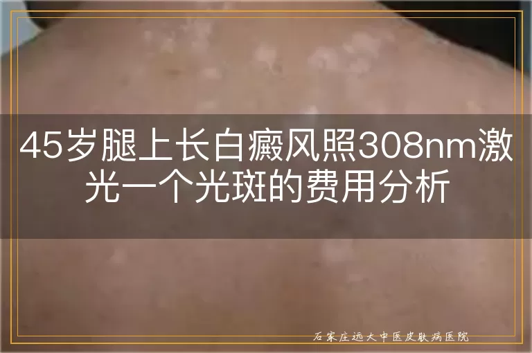 45岁腿上长白癜风照308nm激光一个光斑的费用分析