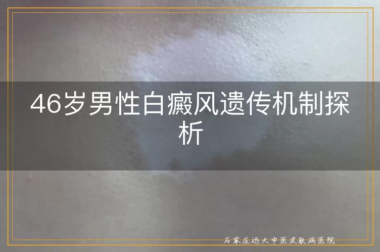 46岁男性白癜风遗传机制探析