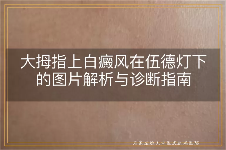 大拇指上白癜风在伍德灯下的图片解析与诊断指南