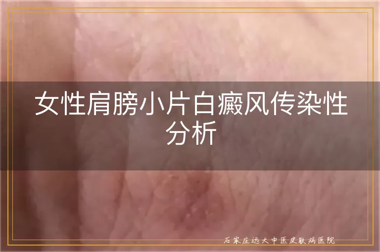 女性肩膀小片白癜风传染性分析