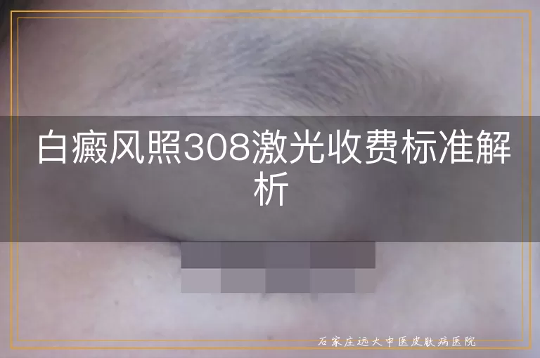 白癜风照308激光收费标准解析