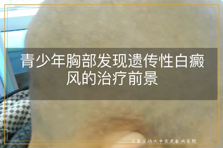 青少年胸部发现遗传性白癜风的治疗前景