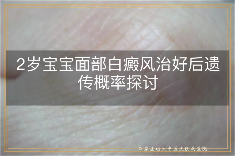 2岁宝宝面部白癜风治好后遗传概率探讨
