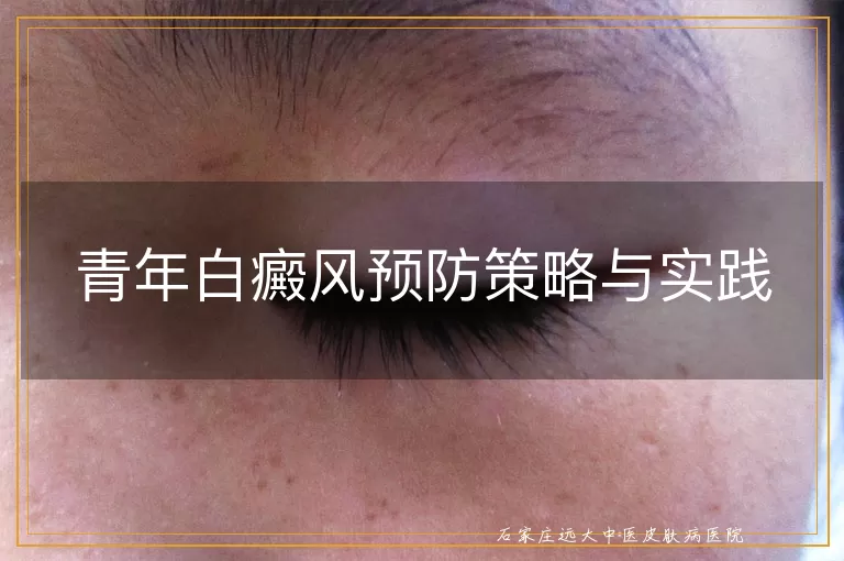 青年白癜风预防策略与实践