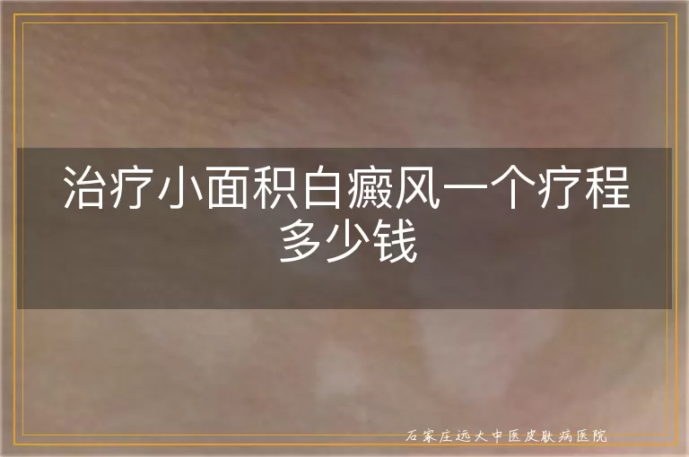 治疗小面积白癜风一个疗程多少钱
