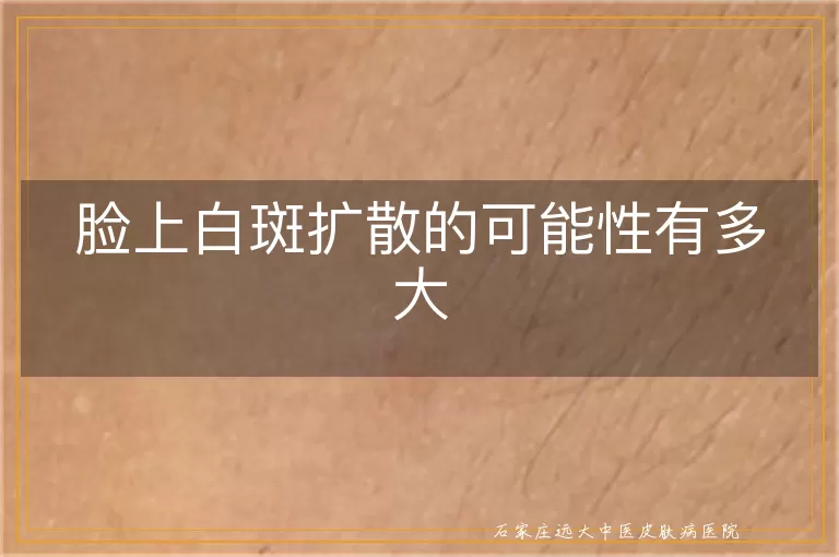 脸上白斑扩散的可能性有多大