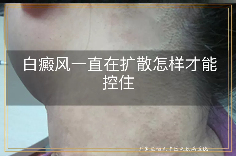 白癜风一直在扩散怎样才能控住